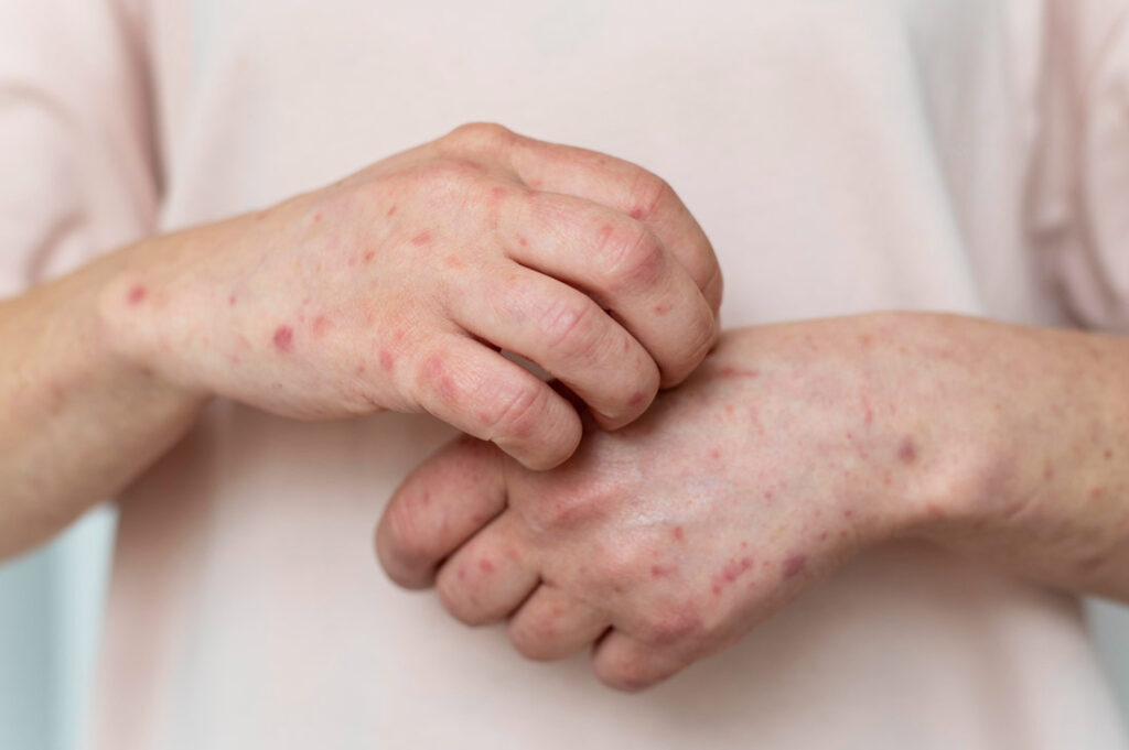 Measles on the rise in 2024